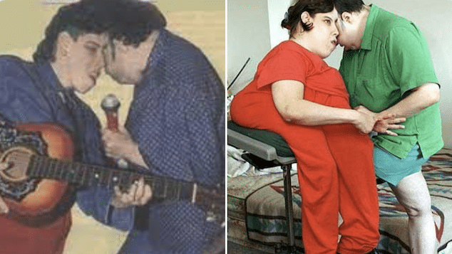 Lori & George Schappell world's oldest conjoined twins dead.